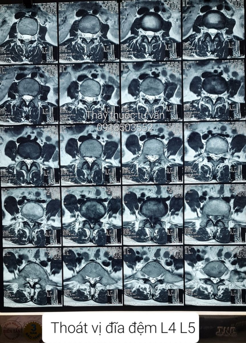 Thoát vị đĩa đệm L4 L5